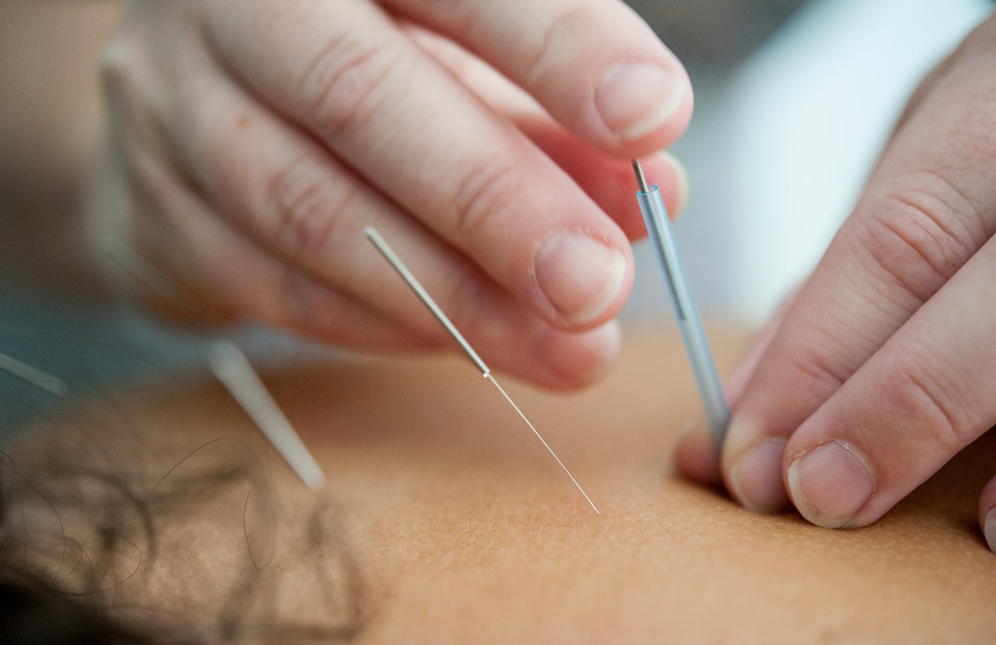 Acupuncture Mini-Sessions